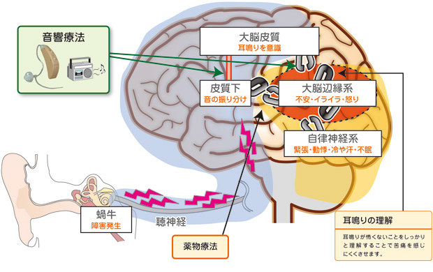 TRT療法イメージ